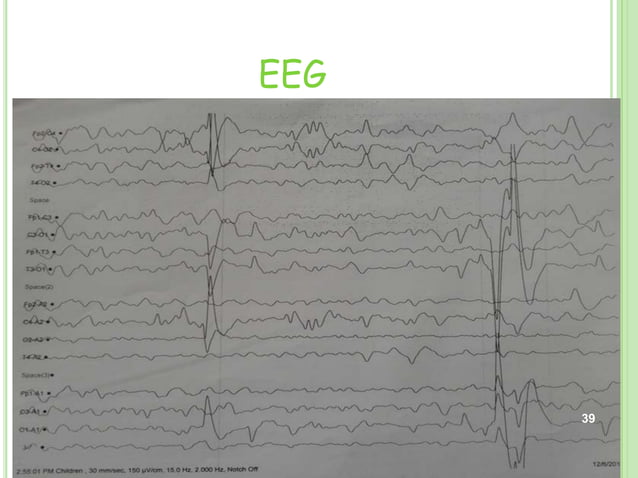 ACUTE INTERMITTENT PORPHYRIA | PPTX | Digestive Disorders | Diseases ...