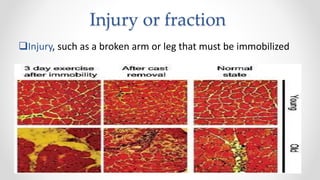 Injury or fraction
Injury, such as a broken arm or leg that must be immobilized
 