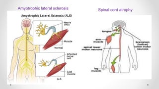 Amyotrophic lateral sclerosis Spinal cord atrophy
 