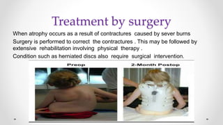 Treatment by surgery
When atrophy occurs as a result of contractures caused by sever burns
Surgery is performed to correct the contractures . This may be followed by
extensive rehabilitation involving physical therapy .
.Condition such as herniated discs also require surgical intervention
 