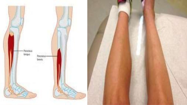 skeletal Muscle atrophy