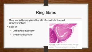 Ring fibres
• Ring formed by peripheral bundle of myofibrils directed
circumferentially
• Seen in
• Limb girdle dystrophy
• Myotonic dystrophy
 