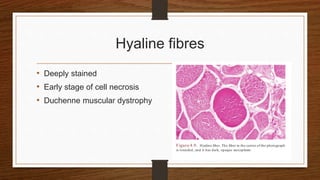 Hyaline fibres
• Deeply stained
• Early stage of cell necrosis
• Duchenne muscular dystrophy
 