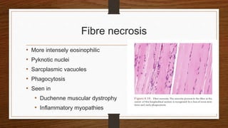 Fibre necrosis
• More intensely eosinophilic
• Pyknotic nuclei
• Sarcplasmic vacuoles
• Phagocytosis
• Seen in
• Duchenne muscular dystrophy
• Inflammatory myopathies
 