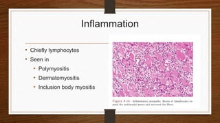 Inflammation
• Chiefly lymphocytes
• Seen in
• Polymyositis
• Dermatomyositis
• Inclusion body myositis
 