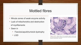 Mottled fibres
• Minute zones of weak enzyme activity
• Lack of mitochondria and destruction
of myofilaments
• Seen in
• Fascioscapulohumeral dystrophy
• LGD
 