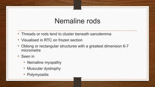 Nemaline rods
• Threads or rods tend to cluster beneath sarcolemma
• Visualised in RTC on frozen section
• Oblong or rectangular structures with a greatest dimension 6-7
micrometre
• Seen in
• Nemaline myopathy
• Muscular dystrophy
• Polymyositis
 