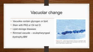Vacuolar change
• Vacuoles contain glycogen or lipid
• Stain with PAS or Oil red O
• Lipid storage diseases
• Rimmed vacuole – oculopharyngeal
dystrophy,IBM
 