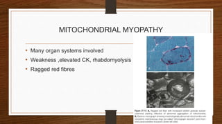 MITOCHONDRIAL MYOPATHY
• Many organ systems involved
• Weakness ,elevated CK, rhabdomyolysis
• Ragged red fibres
 