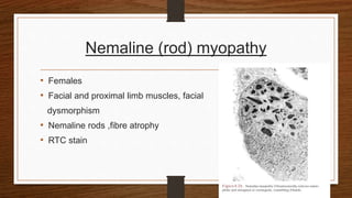 Nemaline (rod) myopathy
• Females
• Facial and proximal limb muscles, facial
dysmorphism
• Nemaline rods ,fibre atrophy
• RTC stain
 