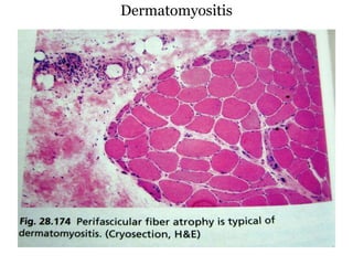 Dermatomyositis
 