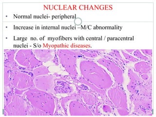NUCLEAR CHANGES
• Normal nuclei- peripheral
• Increase in internal nuclei –M/C abnormality
• Large no. of myofibers with central / paracentral
nuclei - S/o Myopathic diseases.
 