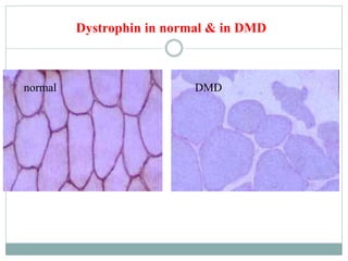 normal DMD
Dystrophin in normal & in DMD
 