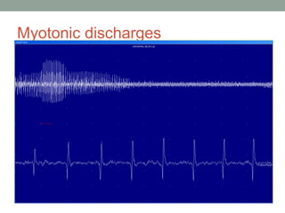 Myotonic discharges
 