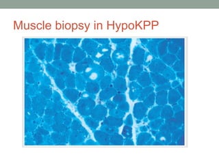 Muscle biopsy in HypoKPP
 