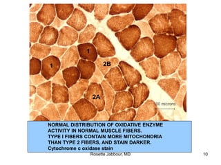 2A
1
2B
1
NORMAL DISTRIBUTION OF OXIDATIVE ENZYME
ACTIVITY IN NORMAL MUSCLE FIBERS.
TYPE I FIBERS CONTAIN MORE MITOCHONDRIA
THAN TYPE 2 FIBERS, AND STAIN DARKER.
Cytochrome c oxidase stain
Rosette Jabbour, MD 10
 