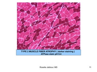 TYPE 2 MUSCLE FIBER ATROPHY ( darker staining )
ATPase stain pH 9.4
Rosette Jabbour, MD 11
 
