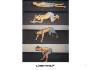 GOWER’S SIGN
Rosette Jabbour, MD 21
 