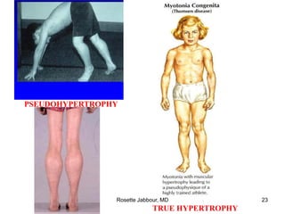 PSEUDOHYPERTROPHY
TRUE HYPERTROPHY
Rosette Jabbour, MD 23
 