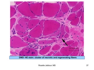 DMD- HE stain: cluster of necrotic and regenerating fibers
Rosette Jabbour, MD 37
 