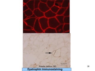 Dystrophin immunostaining
Rosette Jabbour, MD 38
 
