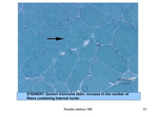 STEINERT- Gomori trichrome stain: increase in the number of
fibers containing Internal nuclei
Rosette Jabbour, MD 51
 