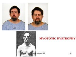 MYOTONIC DYSTROPHY
Rosette Jabbour, MD 52
 