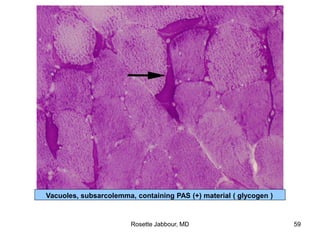 Vacuoles, subsarcolemma, containing PAS (+) material ( glycogen )
Rosette Jabbour, MD 59
 