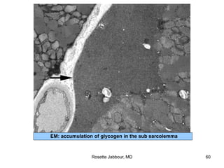 EM: accumulation of glycogen in the sub sarcolemma
Rosette Jabbour, MD 60
 