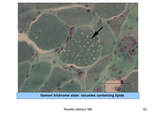 Gomori trichrome stain: vacuoles containing lipids
Rosette Jabbour, MD 62
 