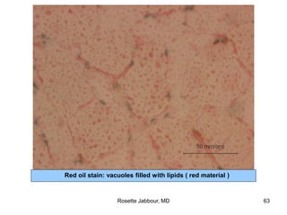 Red oil stain: vacuoles filled with lipids ( red material )
Rosette Jabbour, MD 63
 