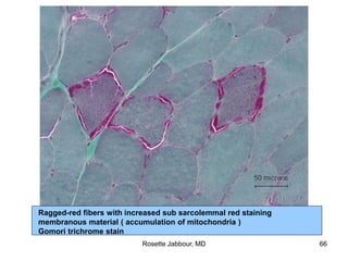 Ragged-red fibers with increased sub sarcolemmal red staining
membranous material ( accumulation of mitochondria )
Gomori trichrome stain
Rosette Jabbour, MD 66
 