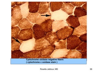 Cytochrome oxidase negative fibers
( cytochrome c oxidase stain )
Rosette Jabbour, MD 68
 