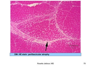 DM- HE stain: perifascicular atrophy
Rosette Jabbour, MD 79
 