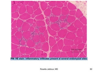 PM- HE stain: inflammatory infiltrates present at several endomysial sites
Rosette Jabbour, MD 80
 