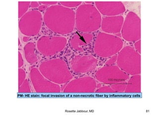 PM- HE stain: focal invasion of a non-necrotic fiber by inflammatory cells
Rosette Jabbour, MD 81
 