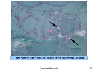 IBM- Gomori trichrome stain: muscle fibers with rimmed vacuoles
Rosette Jabbour, MD 83
 