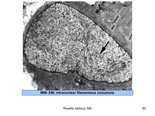 IBM- EM: intranuclear filamentous inclusions
Rosette Jabbour, MD 85
 