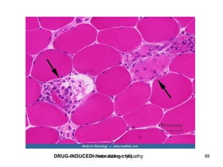 DRUG-INDUCED- Necrotizing myopathy
Rosette Jabbour, MD 88
 