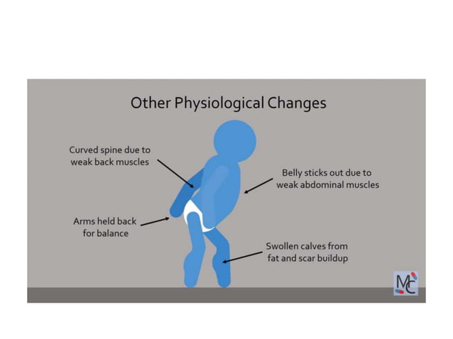 Muscle Disorders muscle-disorders-flashcards-quizlet
