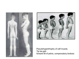 Pseudohypertrhophy of calf muscle,
Tip toe gait
forward tilt of pelvis, compensatory lordosis
 