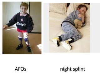 AFOs night splint
 