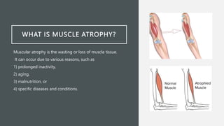 WHAT IS MUSCLE ATROPHY?
Muscular atrophy is the wasting or loss of muscle tissue.
It can occur due to various reasons, such as
1) prolonged inactivity,
2) aging,
3) malnutrition, or
4) specific diseases and conditions.
 