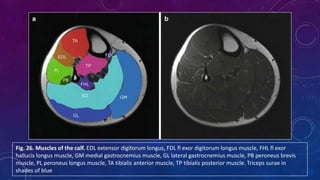 Muscle MRI in Neuromuscular Disease