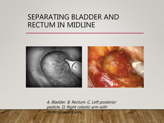 Muscle invasive bladder cancer | PPTX