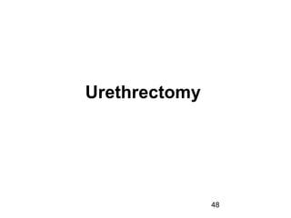 48
Urethrectomy
 