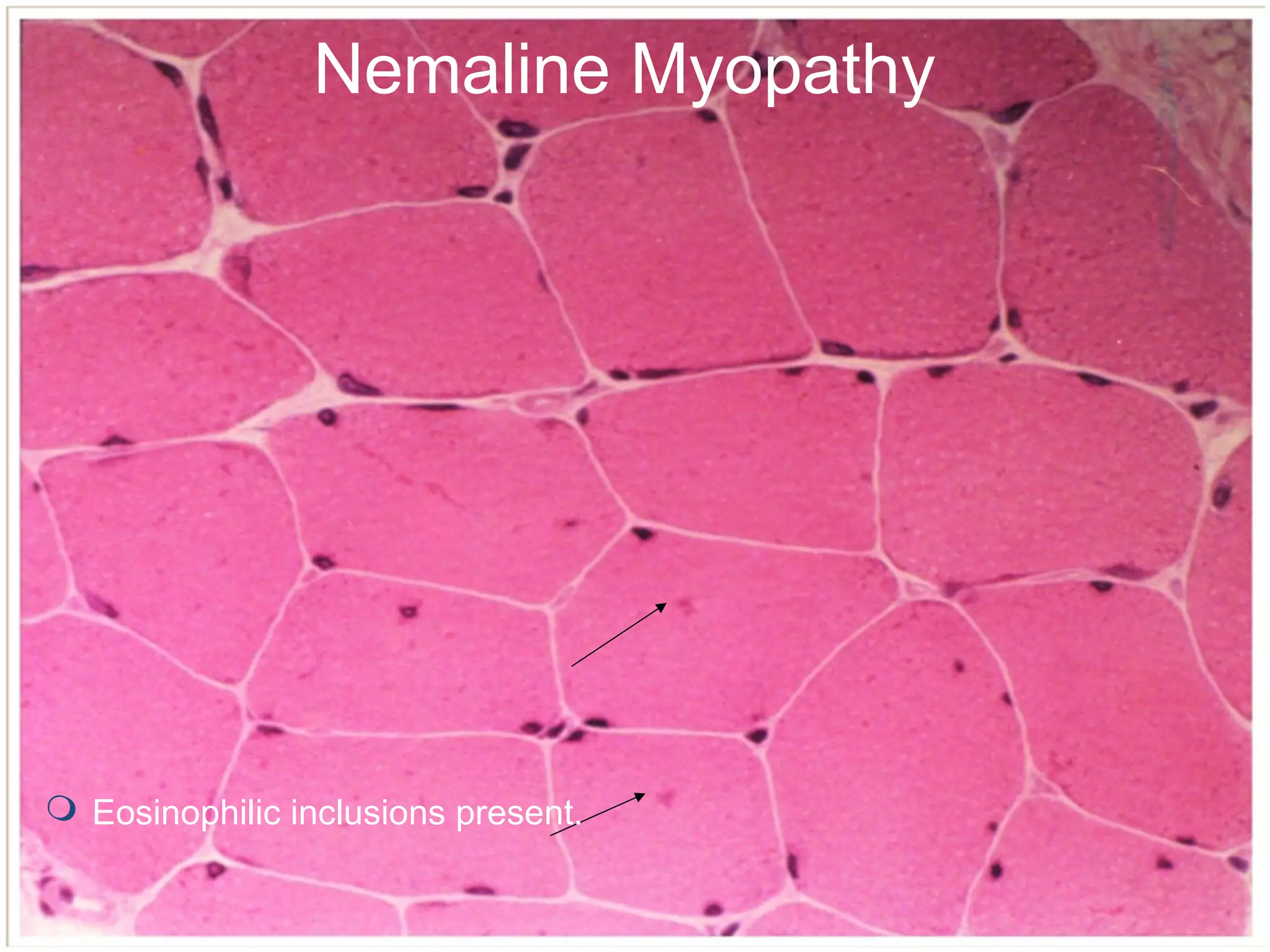 Myopathies - In detail (Classification and images) | PPT
