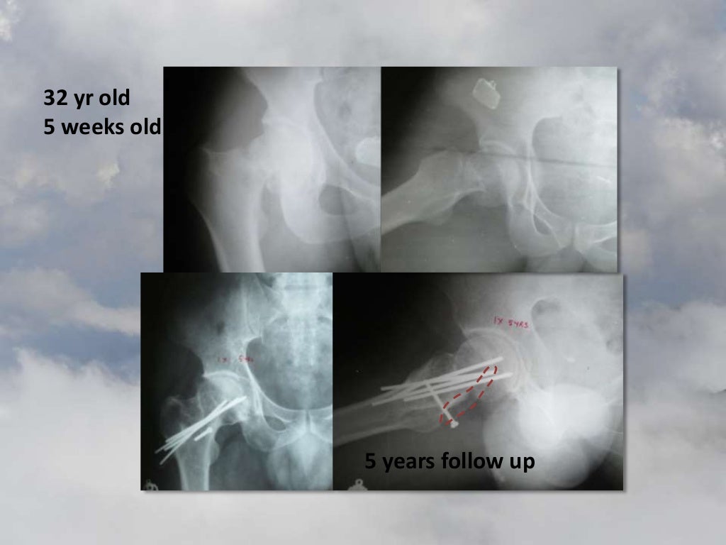 Muscle pedicle grafting for preservation of the Hip by Prof. V.S.Ravi…