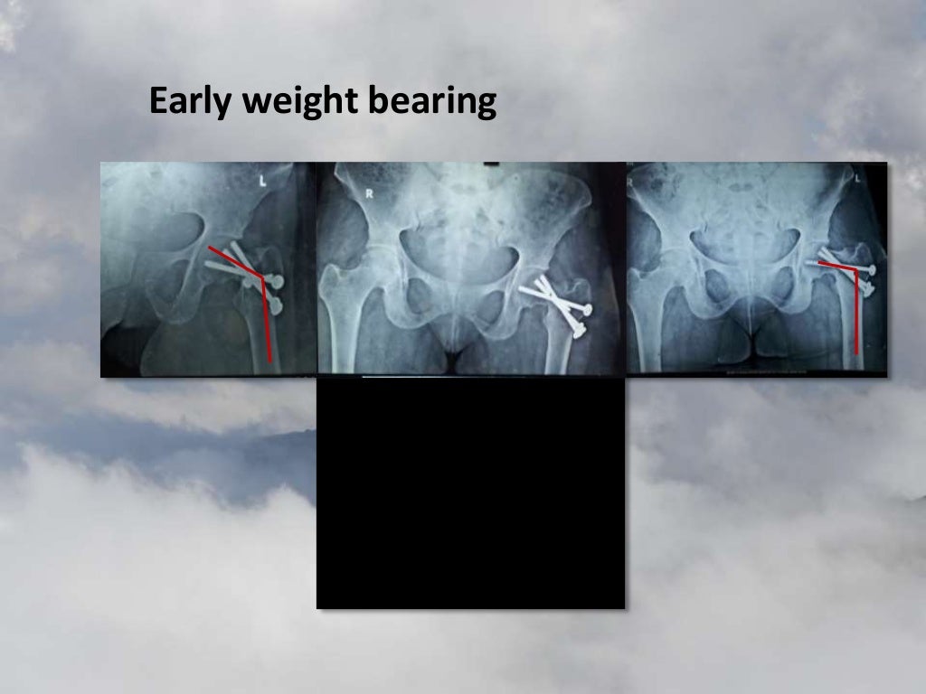 Muscle pedicle grafting for preservation of the Hip by Prof. V.S.Ravi…