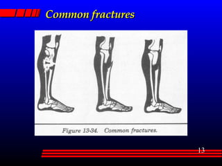 Common fractures 